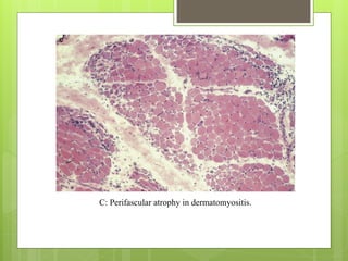 C: Perifascular atrophy in dermatomyositis.
 