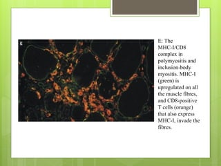 E: The
MHC-I/CD8
complex in
polymyositis and
inclusion-body
myositis. MHC-I
(green) is
upregulated on all
the muscle fibres,
and CD8-positive
T cells (orange)
that also express
MHC-I, invade the
fibres.
 