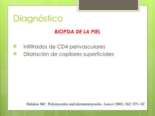 Diagnóstico
BIOPSIA DE LA PIEL
 Infiltrados de CD4 perivasculares
 Dilatación de capilares superficiales
Dalakas MC. Polymyositis and dermatomyositis. Lancet 2003; 362: 971–82
 