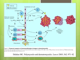 Dalakas MC. Polymyositis and dermatomyositis. Lancet 2003; 362: 971–82
 