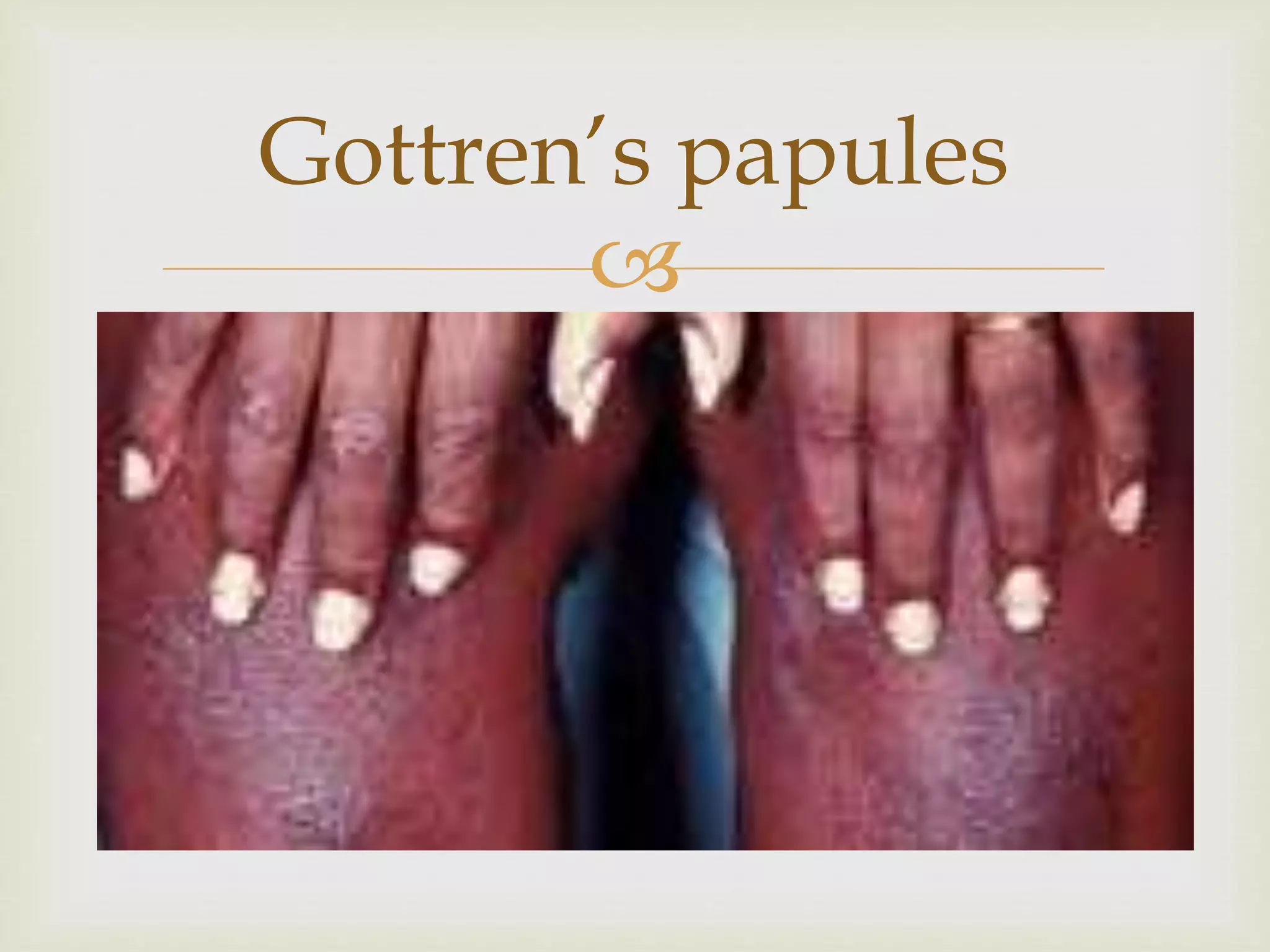 Dermatomyositis | PPTX