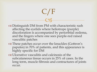 
 Distinguish DM from PM with characteristic rash
affecting the eyelids where heliotrope (purple)
discoloration is accompanied by periorbital oedema,
and the fingers where one sees purple-red raised
vasculitic patches
 These patches occur over the knuckles (Gottron’s
papules) in 70% of patients, and this appearance is
highly specific for DM
 Ulcerative vasculitis and calcinosis of the
subcutaneous tissue occurs in 25% of cases. In the
long term, muscle fibrosis and contractures of joints
occur.
C/F
 