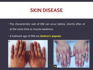 SKIN DISEASE
 The characteristic rash of DM can occur before, shortly after, or
at the same time as muscle weakness.
 A hallmark sign of DM are Gottron's papules
 