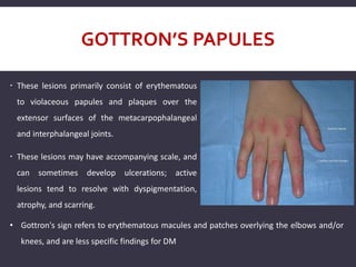 GOTTRON’S PAPULES
 These lesions primarily consist of erythematous
to violaceous papules and plaques over the
extensor surfaces of the metacarpophalangeal
and interphalangeal joints.
 These lesions may have accompanying scale, and
can sometimes develop ulcerations; active
lesions tend to resolve with dyspigmentation,
atrophy, and scarring.
• Gottron's sign refers to erythematous macules and patches overlying the elbows and/or
knees, and are less specific findings for DM
 