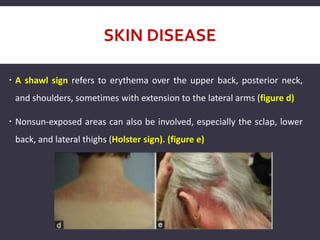 SKIN DISEASE
 A shawl sign refers to erythema over the upper back, posterior neck,
and shoulders, sometimes with extension to the lateral arms (figure d)
 Nonsun-exposed areas can also be involved, especially the sclap, lower
back, and lateral thighs (Holster sign). (figure e)
 