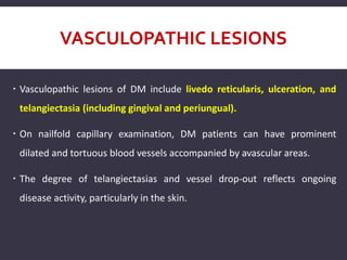 VASCULOPATHIC LESIONS
 Vasculopathic lesions of DM include livedo reticularis, ulceration, and
telangiectasia (including gingival and periungual).
 On nailfold capillary examination, DM patients can have prominent
dilated and tortuous blood vessels accompanied by avascular areas.
 The degree of telangiectasias and vessel drop-out reflects ongoing
disease activity, particularly in the skin.
 