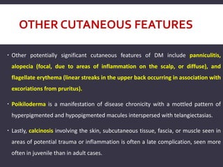 OTHER CUTANEOUS FEATURES
 Other potentially significant cutaneous features of DM include panniculitis,
alopecia (focal, due to areas of inflammation on the scalp, or diffuse), and
flagellate erythema (linear streaks in the upper back occurring in association with
excoriations from pruritus).
 Poikiloderma is a manifestation of disease chronicity with a mottled pattern of
hyperpigmented and hypopigmented macules interspersed with telangiectasias.
 Lastly, calcinosis involving the skin, subcutaneous tissue, fascia, or muscle seen in
areas of potential trauma or inflammation is often a late complication, seen more
often in juvenile than in adult cases.
 