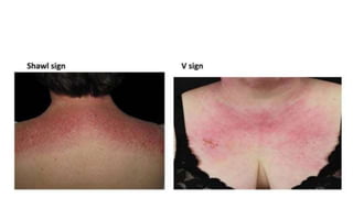 DERMATOMYOSITIS.pptx