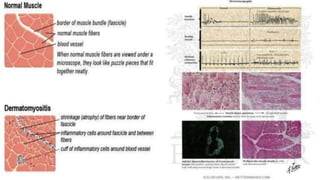 DERMATOMYOSITIS.pptx