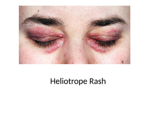 Haliotrop Rash Dermatomyositis.pptx Presenation For medical students lectures | PPTX