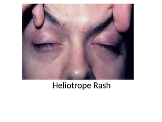 Haliotrop Rash Dermatomyositis.pptx Presenation For medical students lectures | PPTX
