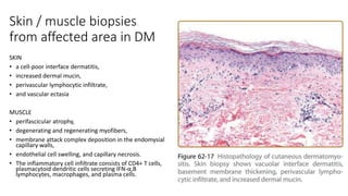 Dermatomyositis diskusi div adi alergi.pptx