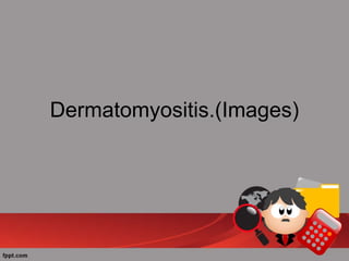 Dermatomyositis.(Images)
 