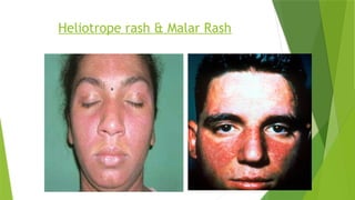 Haliotrop Rash dermatomyositis clinical and diagnosis and management | PPTX