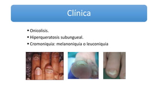 Clínica
 Onicolisis.
 Hiperqueratosis subungueal.
 Cromoniquia: melanoniquia o leuconiquia
 