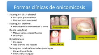 Formas clínicas de onicomicosis
• Subungueal distal y lateral
• Uña opaca, gris-amarillenta
• Hiperqueratosis subungueal
• Subungueal proximal
• Manchas blanco-amarillentas en la lúnula
• Blanca superficial
• Máculas blanquecinas confluentes
• Leuconiquia
• Distrófica total
• Uña opaca
• Toda la lámina está afectada
• Subungueal proximal asociada a paroniquia
• Uña verde-amarillenta
• Inflamación periungueal
 