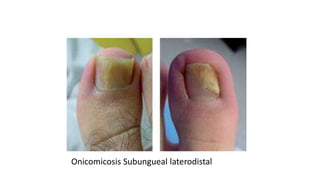 Onicomicosis Subungueal laterodistal
 