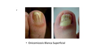 ,
• Onicomicosis Blanca Superficial
 