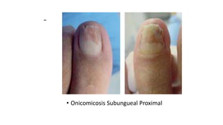 -
• Onicomicosis Subungueal Proximal
 
