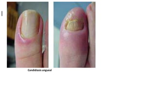 l
Candidiasis ungueal
 