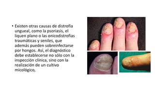 • Existen otras causas de distrofia
ungueal, como la psoriasis, el
liquen plano o las onicodistrofias
traumáticas y seniles, que
además pueden sobreinfectarse
por hongos. Así, el diagnóstico
debe establecerse no sólo con la
inspección clínica, sino con la
realización de un cultivo
micológico,
 
