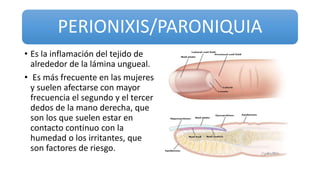 PERIONIXIS/PARONIQUIA
• Es la inflamación del tejido de
alrededor de la lámina ungueal.
• Es más frecuente en las mujeres
y suelen afectarse con mayor
frecuencia el segundo y el tercer
dedos de la mano derecha, que
son los que suelen estar en
contacto continuo con la
humedad o los irritantes, que
son factores de riesgo.
 