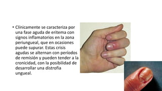 • Clínicamente se caracteriza por
una fase aguda de eritema con
signos inflamatorios en la zona
periungueal, que en ocasiones
puede supurar. Estas crisis
agudas se alternan con períodos
de remisión y pueden tender a la
cronicidad, con la posibilidad de
desarrollar una distrofia
ungueal.
 