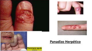 Panadizo Herpético
 
