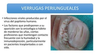 VERRUGAS PERIUNGUEALES
• Infecciones virales producidas por el
virus del papiloma humano.
• Los factores que predisponen a su
aparición son la onicofagia o hábito
de morderse las uñas, ciertas
profesiones que mantengan contacto
frecuente con la humedad y la
inmunodepresión, particularmente
en pacientes trasplantados o con
sida.
 