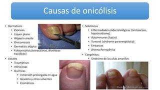 Causas de onicólisis
• Dermatosis
• Psoriasis
• Liquen plano
• Alopecia areata
• Onicomicosis
• Dermatitis atópica
• Fotoonicólisis (tetraciclinas, diuréticos
tiacídicos)
• Locales
• Traumáticas
• Infecciosas
• Químicas
• Inmersión prolongada en agua
• Gasolina y otros solventes
• Cosméticos
• Sistémicas
• Enfermedades endocrinológicas (tirotoxicosis,
hipotiroidismo)
• Autoinmunes (lupus)
• Tumoral (síndrome paraneoplásico)
• Embarazo
• Anemia ferropénica
• Congénitas
• Síndrome de las uñas amarillas
 