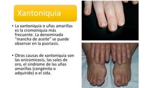Xantoniquia
• La xantoniquia o uñas amarillas
es la cromoniquia más
frecuente. La denominada
“mancha de aceite” se puede
observar en la psoriasis.
• Otras causas de xantoniquia son
las onicomicosis, las sales de
oro, el síndrome de las uñas
amarillas (congénito o
adquirido) o el sida.
 