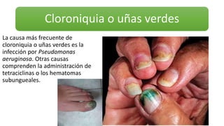 Cloroniquia o uñas verdes
La causa más frecuente de
cloroniquia o uñas verdes es la
infección por Pseudomonas
aeruginosa. Otras causas
comprenden la administración de
tetraciclinas o los hematomas
subungueales.
 