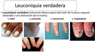 Leuconiquia verdadera
• Leuconiquia verdadera (alteración blanca opaca del color de la placa ungueal,
atribuible a una disfunción de la matriz).
L. total L. punteada L. transversal L. longitudinal
 