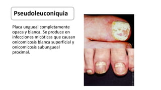 Pseudoleuconiquia
Placa ungueal completamente
opaca y blanca. Se produce en
infecciones micóticas que causan
onicomicosis blanca superficial y
onicomicosis subungueal
proximal.
 