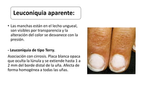 Leuconiquia aparente:
• Las manchas están en el lecho ungueal,
son visibles por transparencia y la
alteración del color se desvanece con la
presión.
- Leuconiquia de tipo Terry.
Asociación con cirrosis. Placa blanca opaca
que oculta la lúnula y se extiende hasta 1 a
2 mm del borde distal de la uña. Afecta de
forma homogénea a todas las uñas.
 