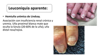 Leuconiquia aparente:
• Hemiuña urémica de Lindsay.
Asociación con insuficiencia renal crónica y
uremia. Uña proximal blanca mate que
oculta la lúnula (20-60% de la uña); uña
distal rosa/rojiza.
 
