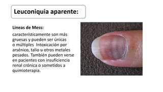 Lineas de Mess:
característicamente son más
gruesas y pueden ser únicas
o múltiples Intoxicación por
arsénico, talio u otros metales
pesados. También pueden verse
en pacientes con insuficiencia
renal crónica o sometidos a
quimioterapia.
Leuconiquia aparente:
 
