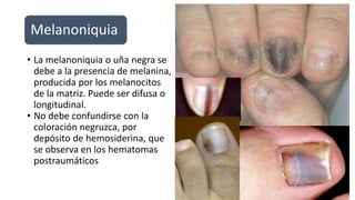 Melanoniquia
• La melanoniquia o uña negra se
debe a la presencia de melanina,
producida por los melanocitos
de la matriz. Puede ser difusa o
longitudinal.
• No debe confundirse con la
coloración negruzca, por
depósito de hemosiderina, que
se observa en los hematomas
postraumáticos
 