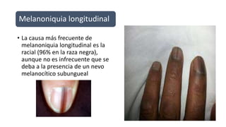 Melanoniquia longitudinal
• La causa más frecuente de
melanoniquia longitudinal es la
racial (96% en la raza negra),
aunque no es infrecuente que se
deba a la presencia de un nevo
melanocítico subungueal
 