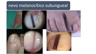 nevo melanocítico subungueal
 
