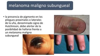 melanoma maligno subungueal
• la presencia de pigmento en los
pliegues proximales o laterales
de la uña, denominado signo de
Hutchinson, debe alertar de la
posibilidad de hallarse frente a
un melanoma maligno
subungueal
 