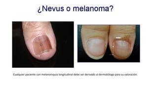 Cualquier paciente con melanoniquia longitudinal debe ser derivado al dermatólogo para su valoración.
 