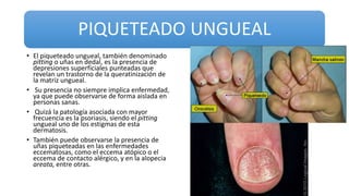 PIQUETEADO UNGUEAL
• El piqueteado ungueal, también denominado
pitting o uñas en dedal, es la presencia de
depresiones superficiales punteadas que
revelan un trastorno de la queratinización de
la matriz ungueal.
• Su presencia no siempre implica enfermedad,
ya que puede observarse de forma aislada en
personas sanas.
• Quizá la patología asociada con mayor
frecuencia es la psoriasis, siendo el pitting
ungueal uno de los estigmas de esta
dermatosis.
• También puede observarse la presencia de
uñas piqueteadas en las enfermedades
eccematosas, como el eccema atópico o el
eccema de contacto alérgico, y en la alopecia
areata, entre otras.
 