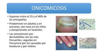 ONICOMICOSIS
• Suponen entre el 15 y el 40% de
las onicopatías.
• Predominan en adultos y en
ancianos, son raras en los niños
y excepcionales en lactantes.
• Las onicomicosis por
dermatofitos son las más
frecuentes, seguidas en
frecuencia por las causadas por
levaduras y por mohos.
 