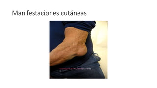 Manifestaciones cutáneas
 