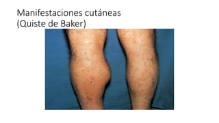 Manifestaciones cutáneas
(Quiste de Baker)
 