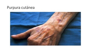Purpura cutánea
 