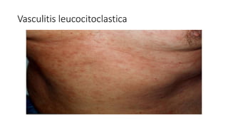 Vasculitis leucocitoclastica
 