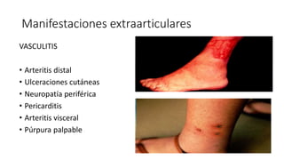 Manifestaciones extraarticulares
VASCULITIS
• Arteritis distal
• Ulceraciones cutáneas
• Neuropatía periférica
• Pericarditis
• Arteritis visceral
• Púrpura palpable
 