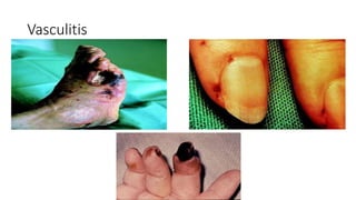 Vasculitis
 